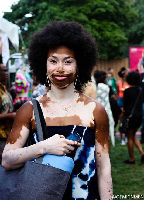 8 Girls with Vitiligo Bare All for Brock Elbank Shoot; Share Reactions